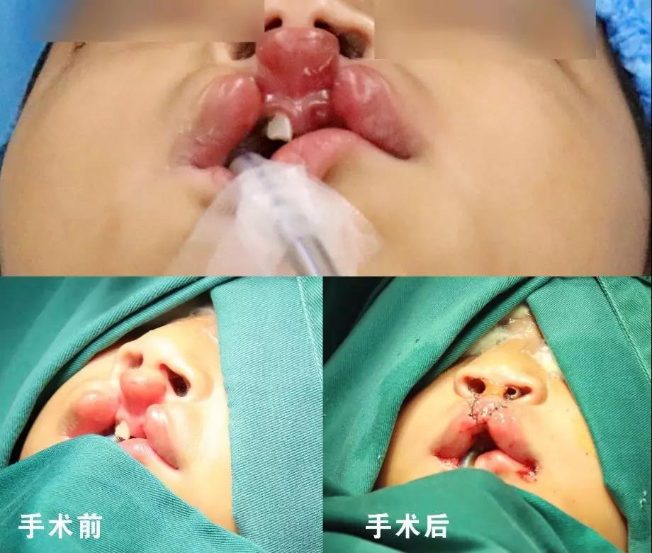 唇腭裂盡早治療消除孩子自卑心理，快樂成長！
