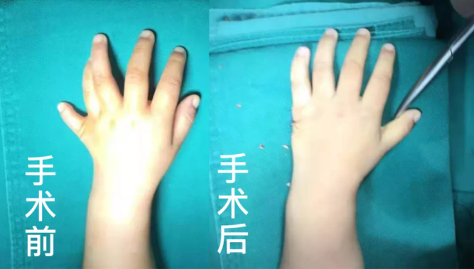 【保山安利醫(yī)院】2歲小兒手、足多指（趾）成功修復(矯正）！
